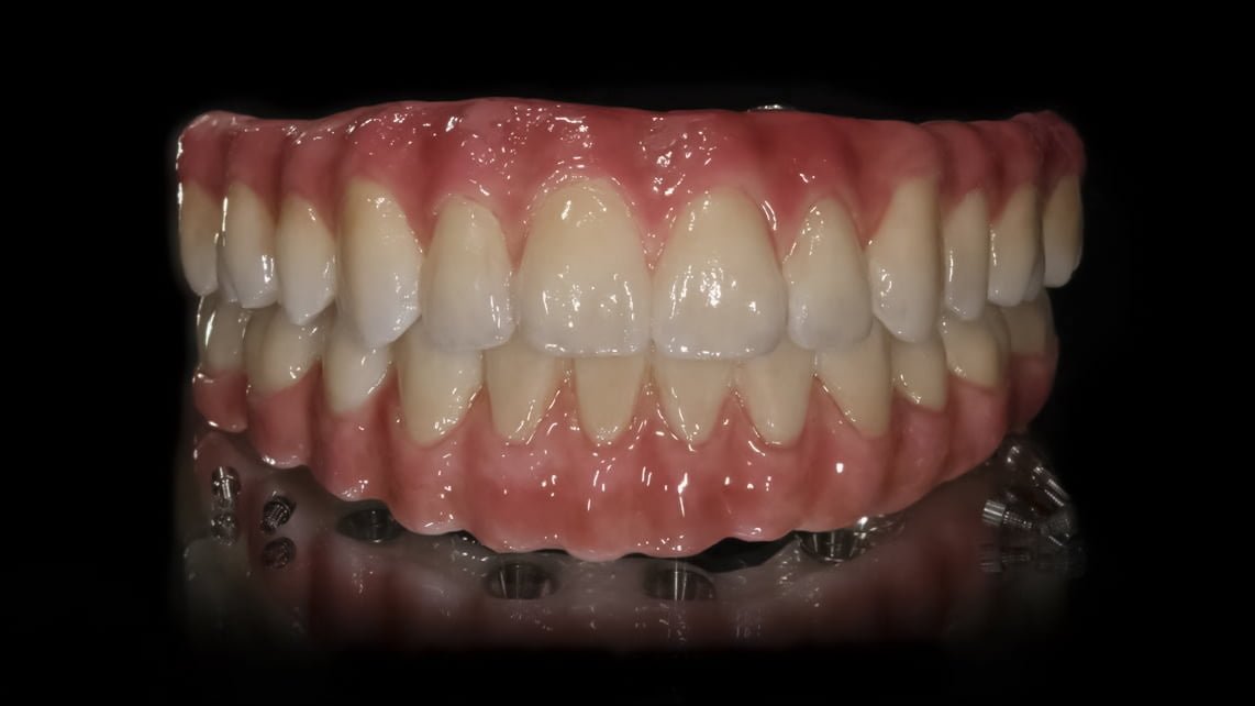 Prótesis dentales para sistema All on 4 Superior e Inferior