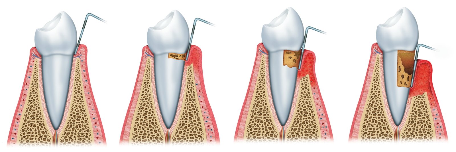 Gingivitis - Periodontitis - Retracción de Encías