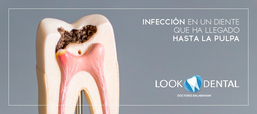 Endodoncia por Infección