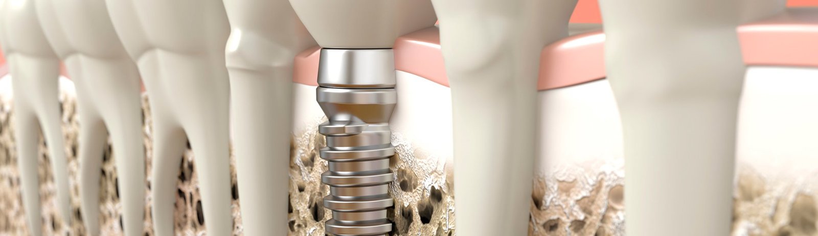 Banner Implante Dental