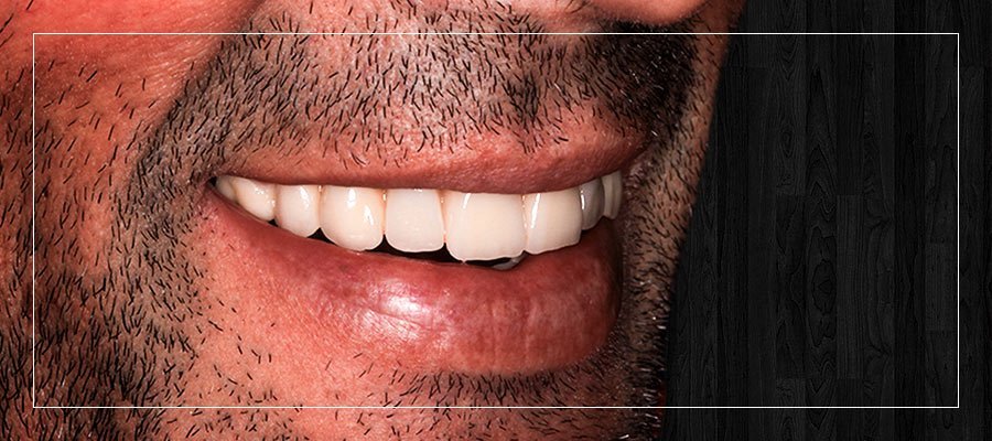 Rehabilitaciones completas