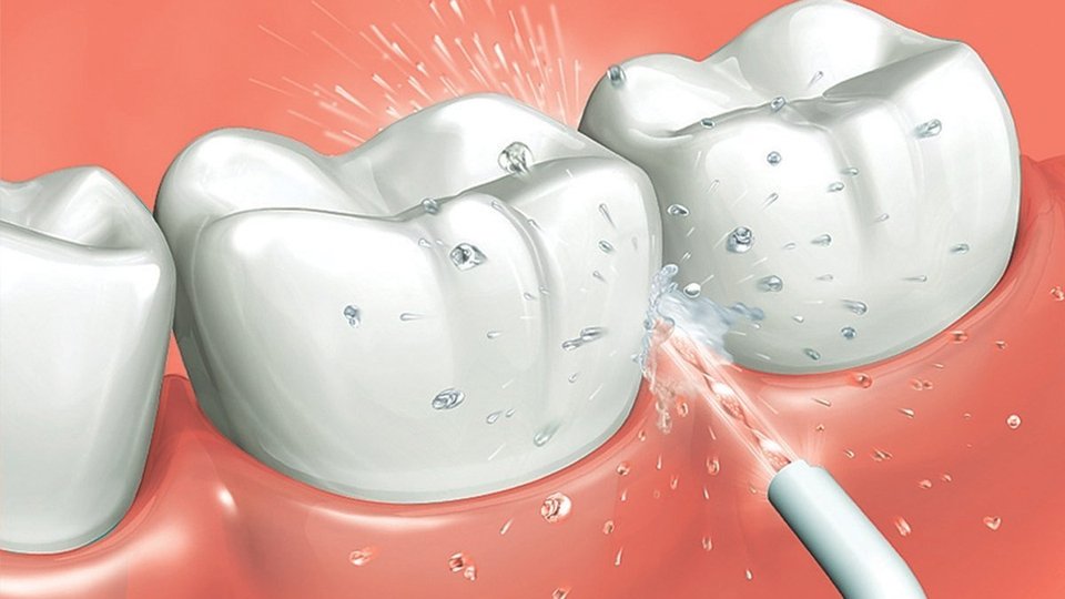 Detalle de los Irrigadores bucales