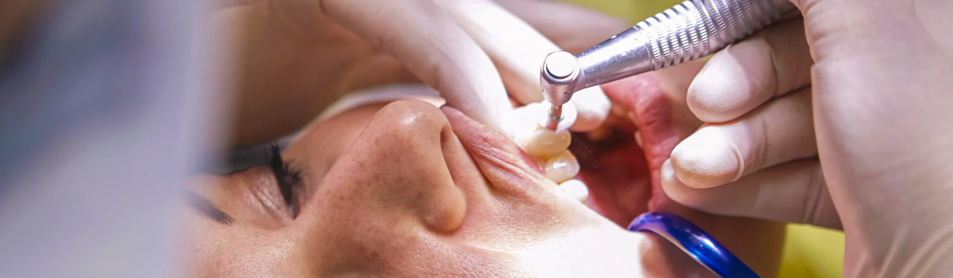 Como se cura la Caries Dental