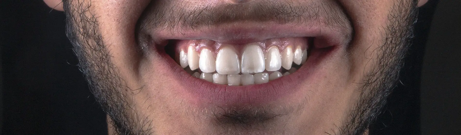El Color Natural de los Dientes