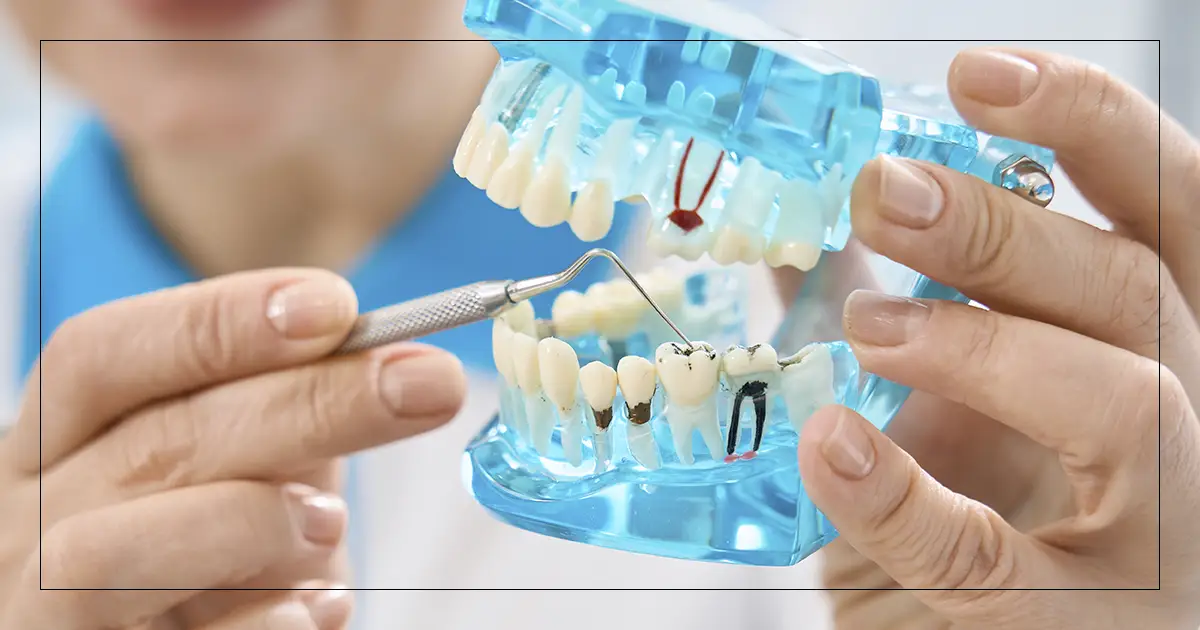 Ejemplos de Caries Dental