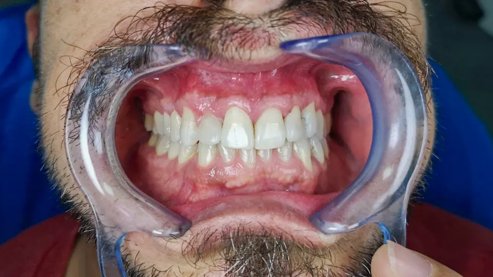 Implante dental en Ibiza