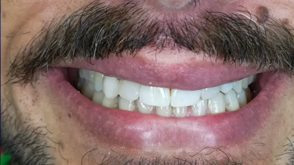 Implante dental en Ibiza