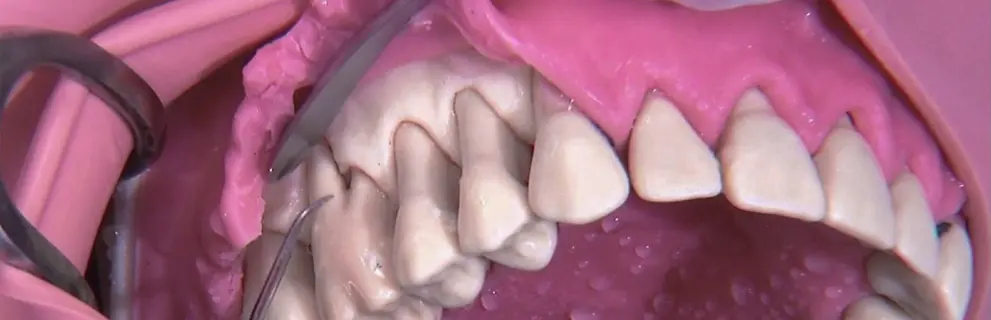Cirugía Periodontal