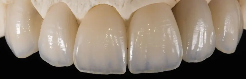Coronas Estéticas de Zirconio en Look Dental