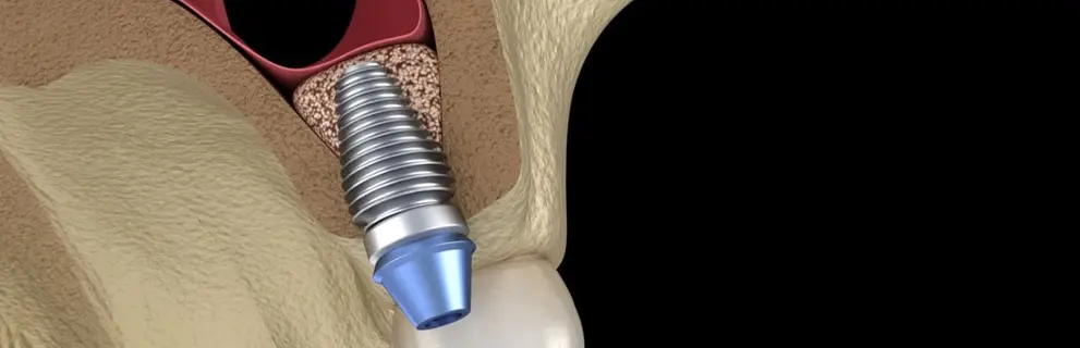 Elevación de Seno Maxilar