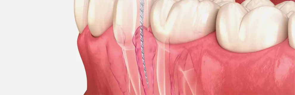 Endodoncia en Clínica Look Dental