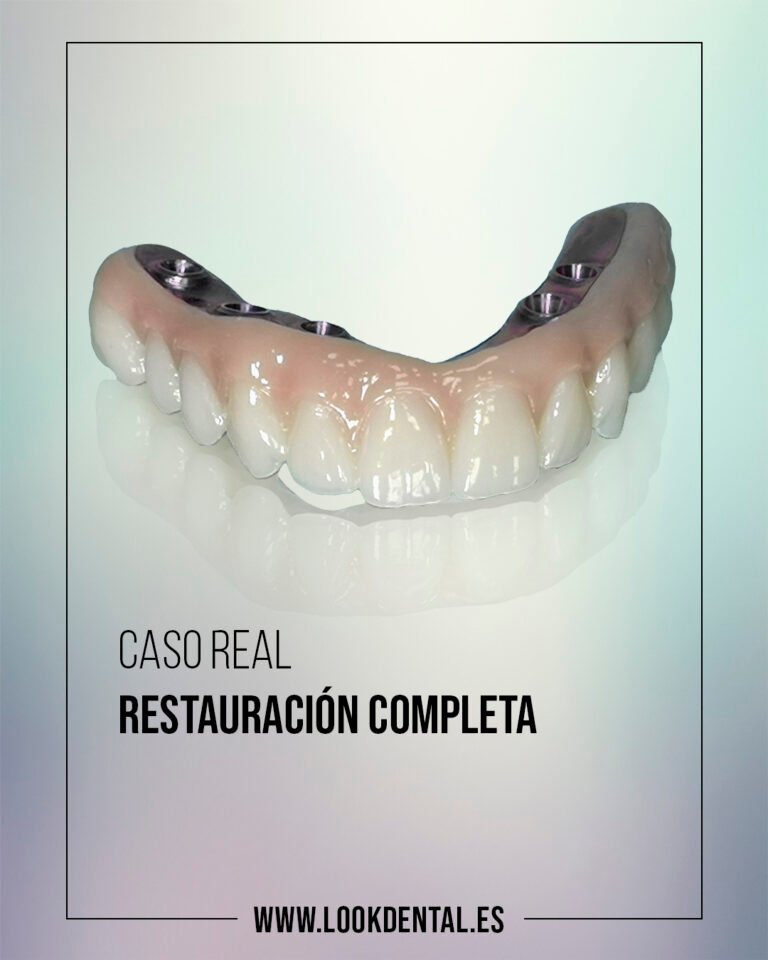 Restauración completa con 4 implantes dentales.