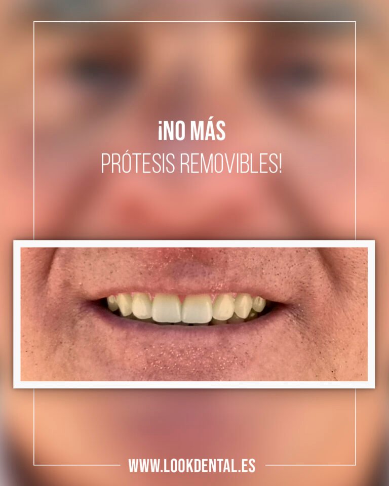 ¡No más prótesis removibles!