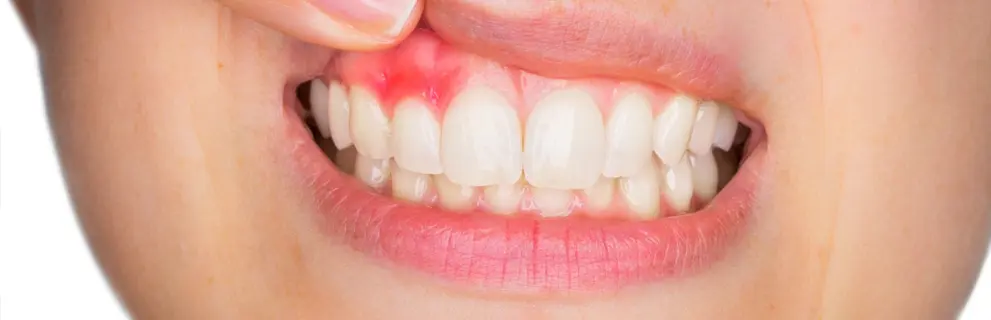 Gingivitis en Look Dental