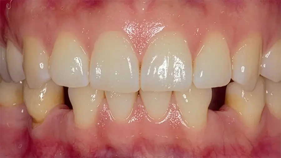 Ausencia de dos piezas dentales.