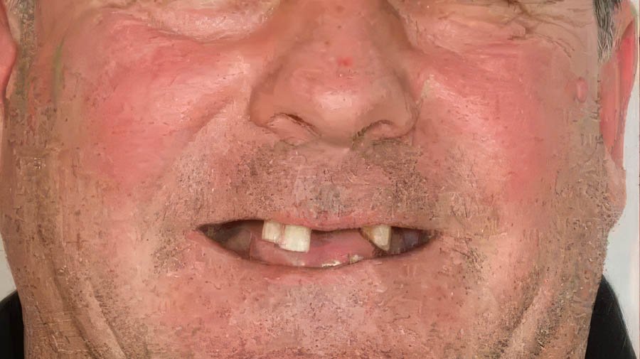 Paciente sin piezas viables.