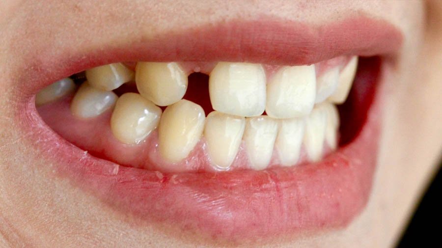 Ausencia de pieza por Ortodoncia.