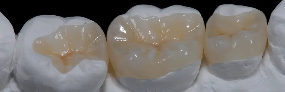 Incrustaciones Dentales