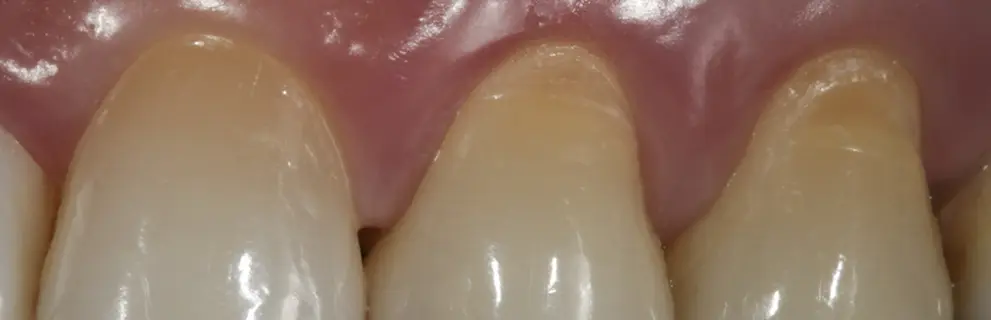 Lesiones No Cariosas