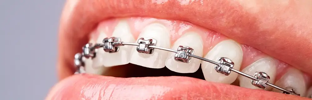 Ortodoncia Autoligable en Look Dental