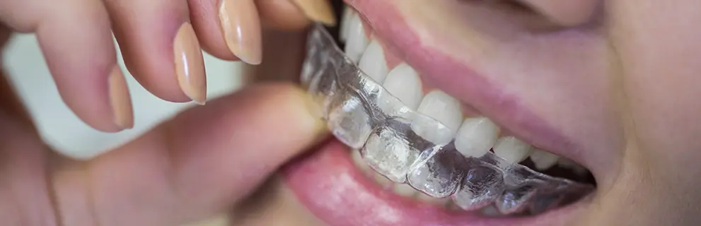 Ortodoncia Invisible en Look Dental