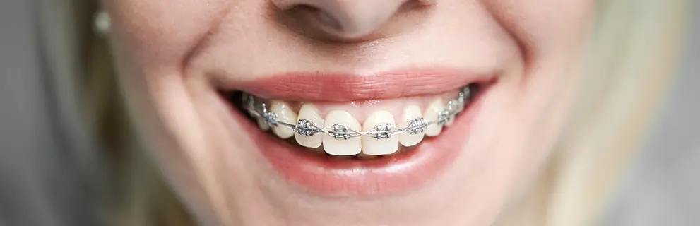 Ortodoncia con Brackets
