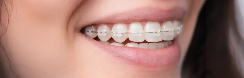 Ortodoncia de Zafiro en Look Dental