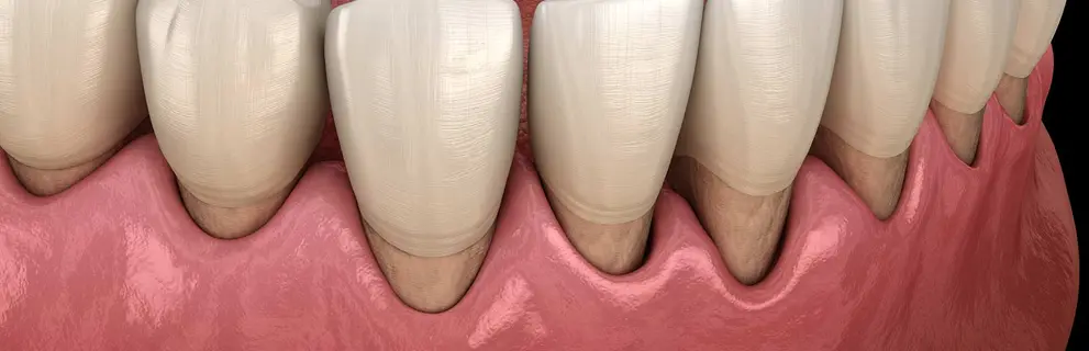 Periodontitis en Clínica Look Dental