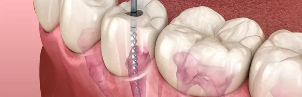 Re endodoncia en Look Dental