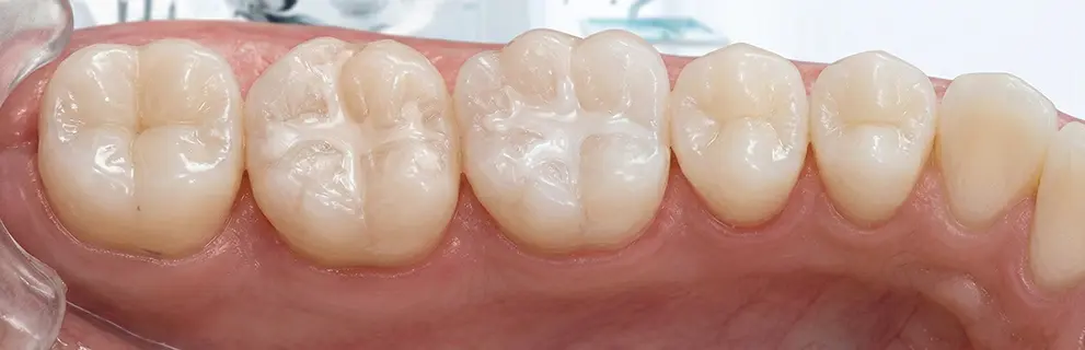 Sellado Dental en Look Dental