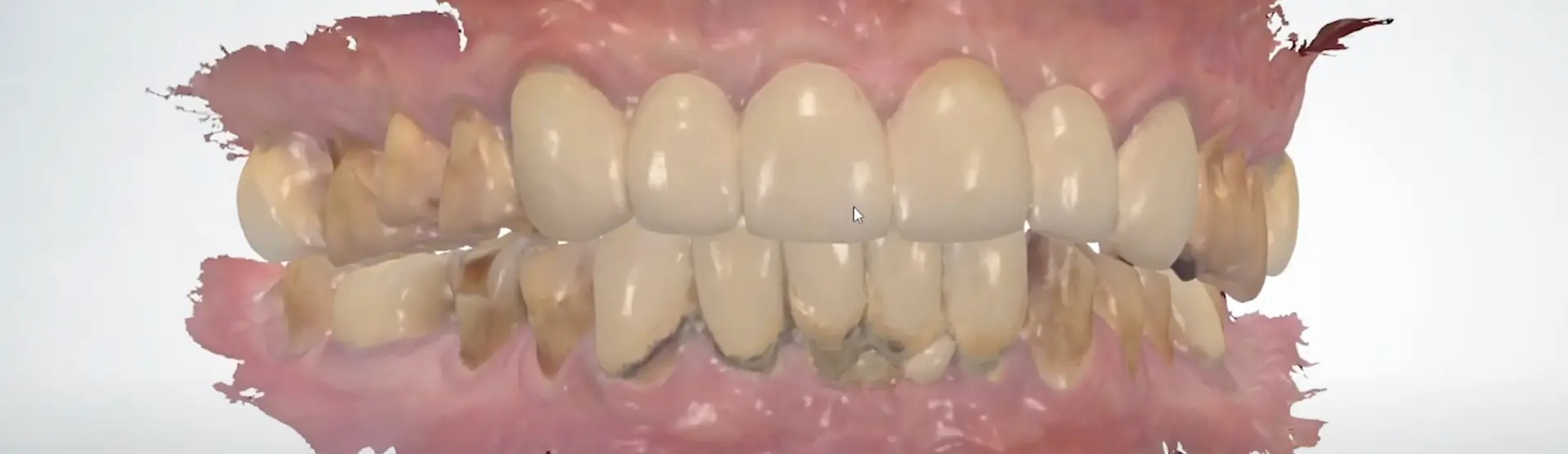 Toma de Impresión Dental Digital